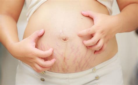 Puppp Rash In Pregnancy Symptoms Causes And Treatment