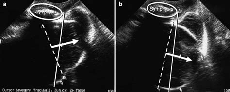 Intrapartum Translabial Ultrasound Itu To Assess Birth Progress