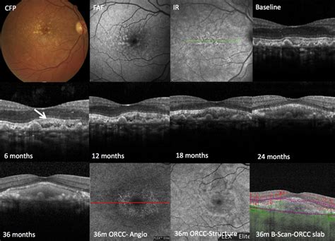 Interpretation of Subretinal Fluid Using OCT in Intermediate Age-Related Macular Degeneration ...