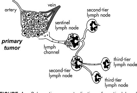 Figure From Radioguided Sentinel Lymph Node Biopsy In Breast Cancer