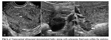 Figure 3 From Invasive Mole Of The Uterus A Rare Case Diagnosed By Ultrasound A Case Report