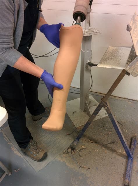 Process For Getting A Prosthesis Atlantic Prosthetics Inc