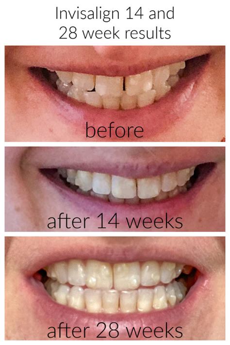 14 Week Invisalign Results 28 Week Invisalign Results