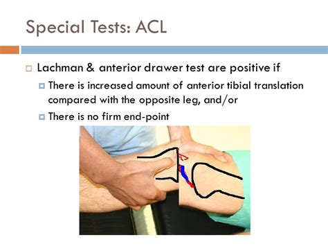 positive anterior drawer test - Caption Simple