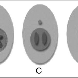 Variations of hymenal anatomy. A. Normal central hymenal orifice; B.... | Download Scientific ...