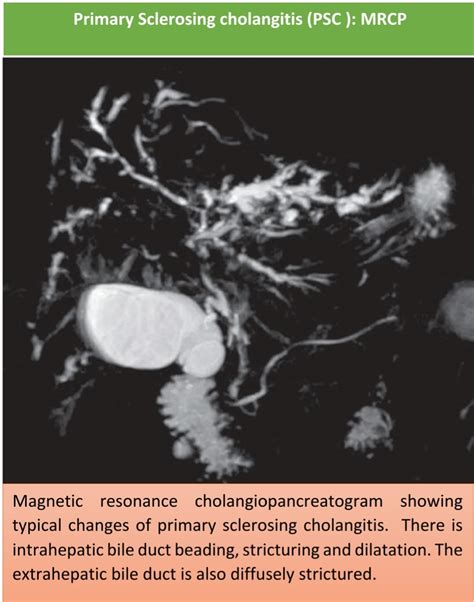 What Is Primary Sclerosing Cholangitis Psc