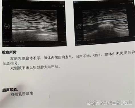 乳头越来越大是什么原因引起的？