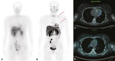 Scielo Brasil Ga Dotatate Pet Ct Versus In Octreotide