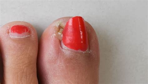 Paronychia Beste Tips Om Te Behandelen Pedicuregroep