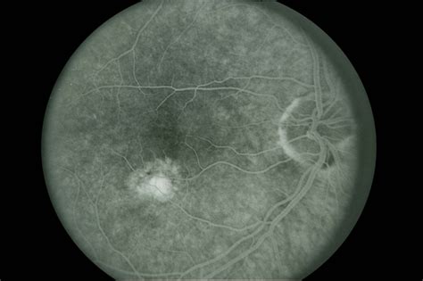 Presumed Ocular Histoplasmosis Syndrome Retina Image Bank