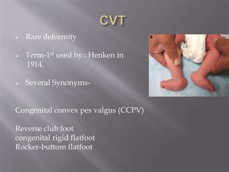 Congenital vertical talus