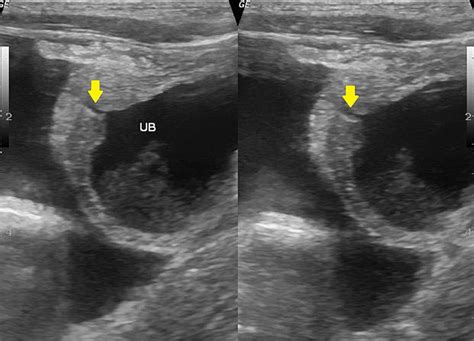 High Resolution Ultrasonography Image Of The Pelvis Demonstrating