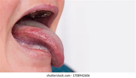 4 Acute glossitis 图片、库存照片和矢量图 | Shutterstock