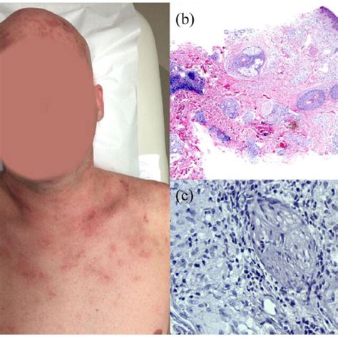 Uncommon And Rare Cutaneous Variants Of Sarcoidosis Download Scientific Diagram