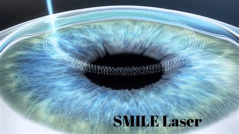 SMILE Laser Surgery Causes Symptoms EyeMantra