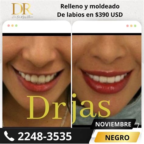 Moldeo De Labios En Solo Usd Dr Eric Rojas Dermatolog A