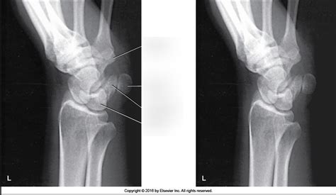 Figure Ap Oblique Wrist Diagram Quizlet