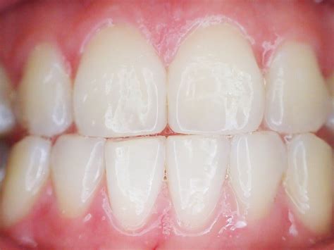 What are Mamelons on Teeth, and how to remove them?