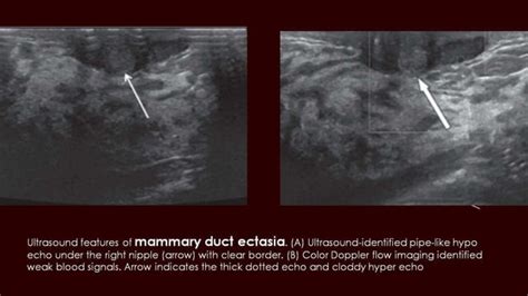 Breast Duct Ectasia Us Mammogram Mri