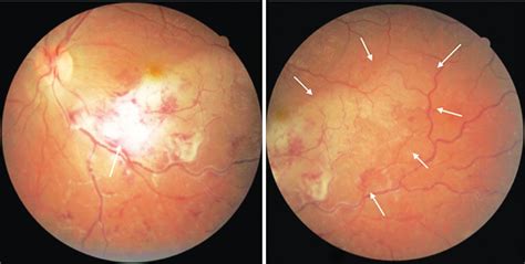 Scielo Brasil Combined Branch Retinal Vein And Artery Occlusion In