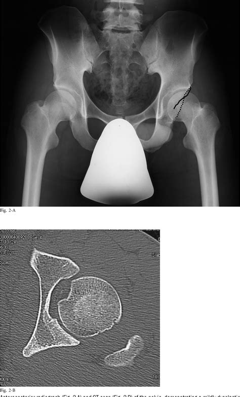 Figure 2 From Recurrent Posterior Dislocation Of The Hip Treated With