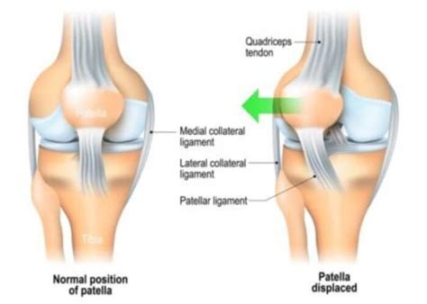 Patellar Dislocation Injury Kneecap Instability Orthopedic Knee