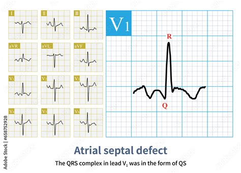 Male Years Old Clinically Diagnosed With Secundum Atrial Septal