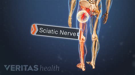 Understanding Sciatica Symptoms Pins And Needles Numbness Icy And