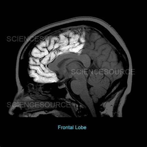 Frontal Lobe Sagittal MRI Stock Image Science Source Images