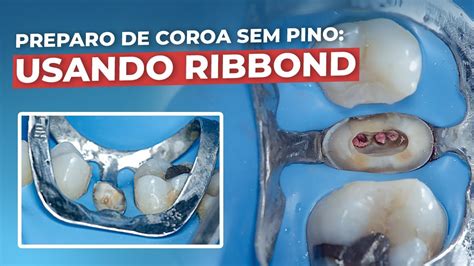 Coroa Provisoria Sem Pino - Coroa Provisória Sem Pino - RETOEDU