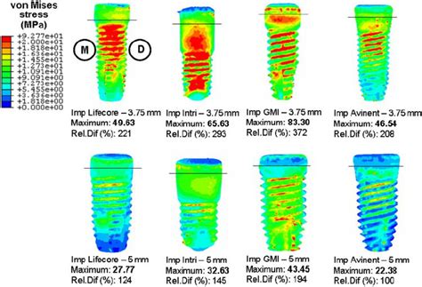 Von Mises Stress Mpa In Dental Implants For Bonded Bone Implant Download Scientific Diagram