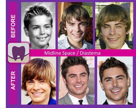 Celebrity Smiles Revealed: Zac Efron • Stouffville SMILES Dentistry ...