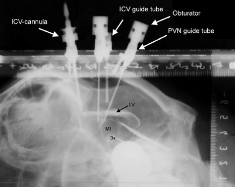 Example Of A Radiograph Used In The Placement Of The PVN Cannulae