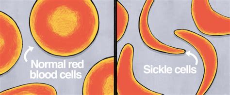 Can Gene Therapy Cure Sickle Cell Disease