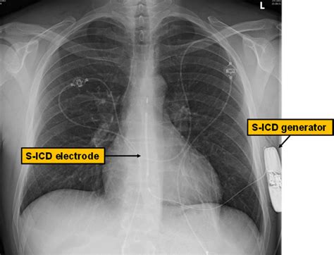 Chest X-ray of a male patient after S-ICD implantation. The generator... | Download Scientific ...