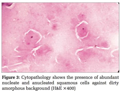 Epidermal Inclusion Cyst Cytology