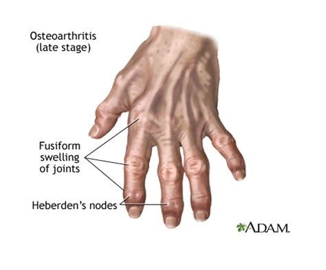 Rheumatoid Arthritis vs. Osteoarthritis ~ THE DOCTOR IS IN – The Valley Patriot