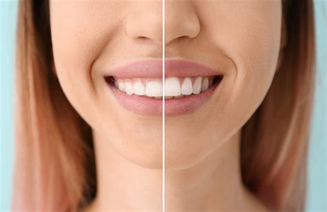 How Much Does Gum Recontouring Cost L Ellicott City Smiles