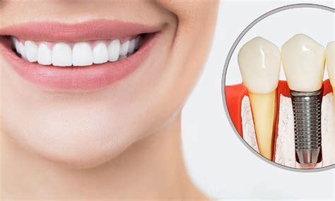 How Long Do Dental Implants Last And How To Ensure Their Longevity