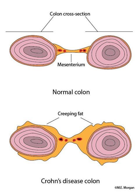 Creeping Fat Chron Gastro Crohns Fat Go With Your Gut