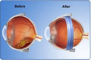 17+ best images about Scleral buckle on Pinterest | Posts, Assessment ...