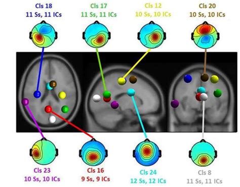 Resultados do EEG indicando as áreas de atividade Fonte Banaei et