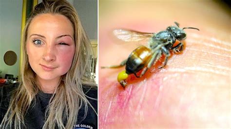 Navigating The Risks And Realities Of Bee Stings Youtube