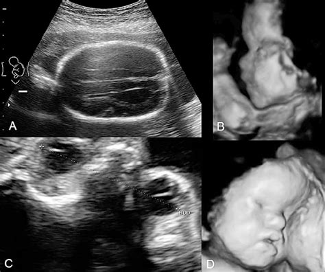 Obstetric Ultrasound Normal Vs Abnormal Images Fetal 43 Off