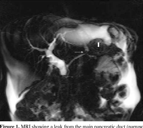 Figure From Laparoscopy Assisted Transjejunal Ercp For Treatment Of