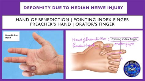 Hand Of Benediction Pointing Index Finger Median Nerve Injury