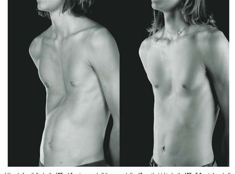 Figure From The Vacuum Bell For Treatment Of Pectus Excavatum An