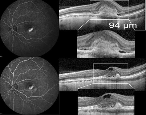 A Subfoveal Choroidal Neovascularization CNV Image Of A Patient