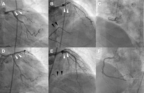 (A) Total occlusion of the left anterior descending coronary artery... | Download Scientific Diagram