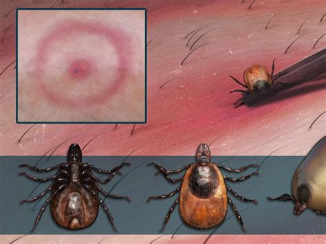 Deer Ticks Can Cause Lyme Disease Heres How To Identify And Treat A